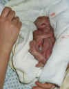 Emil, baby in Anencephalie