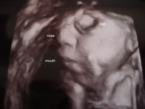 Faith Elizabeth, baby with anencephaly 3D ultrasound at 8 months
