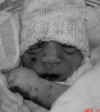 Joey, baby with anencephaly