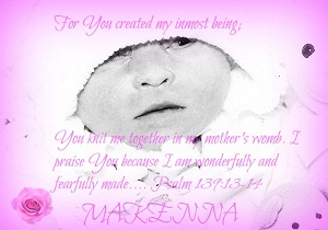 Makenna, baby with anencephaly