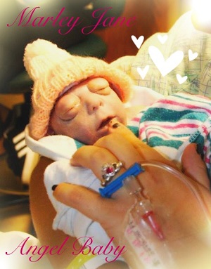 Marley Jane, baby with anencephaly