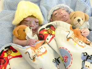 Matthew James and Noah Ryleigh, identical twins with anencephaly