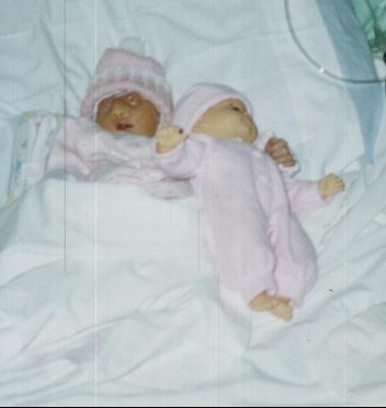 Michaela Hope, baby in Anenzephalie