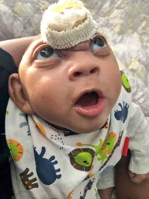 Ozzie Isaiah, baby with anencephaly and encephalocele
