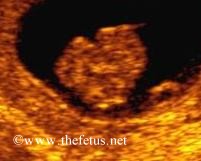 coronal section anencephaly 10 weeks