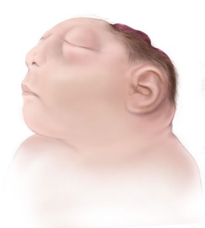 Illustration of a baby with anencephaly