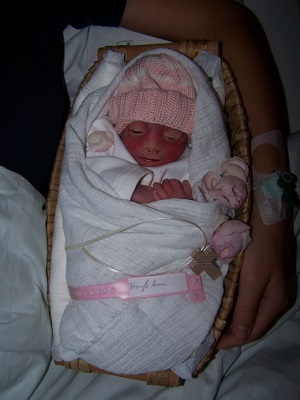 Anna Strauss, baby in Anencephalie