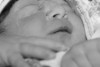 Antony, baby with anencephaly