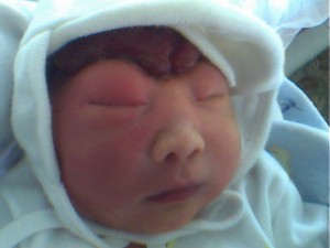 Carmen Arviansyah, baby with anencephaly