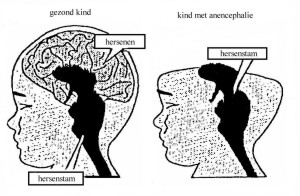 Diagram anencefalie