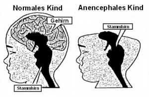 Diagramm eines Babys in Anencephalie