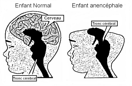 Diagramme Anencéphalie