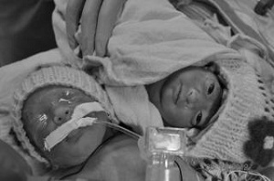 Elizabeth and Lauren, monoamniotic monochorionic twins discordant for anencephaly