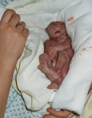 Emil, baby in Anenzephalie