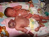 Emily and Hayden, twins discordant for anencephaly