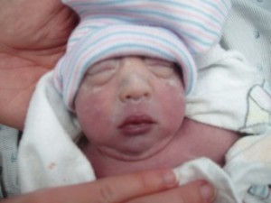 pictures of babies with anencephaly
