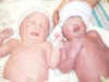 Faith and Sarah, baby with anencephaly