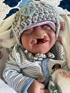 Gabriel Jude, baby with anencephaly