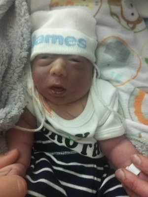 James Henry, baby with anencephaly