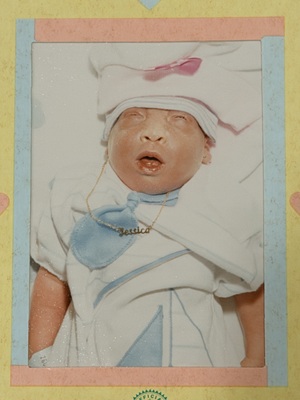 Jesica, baby with anencephaly