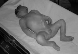 Joseph Jerome, baby with anencephaly