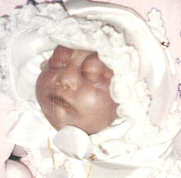 Joyann, baby with anencephaly