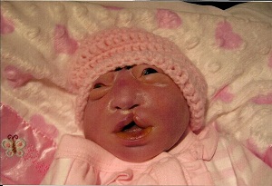 Juliana Lucille, baby with anencephaly