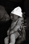 Leila, baby with anencephaly