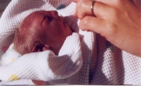 Loren Joseph, baby with anencephaly