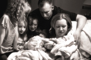 Madeline and Molly, twins discordant for anencephaly