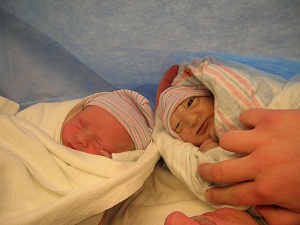 Madeline and Molly, twins discordant for anencephaly