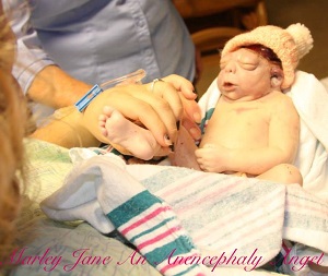 Marley Jane, baby with anencephaly