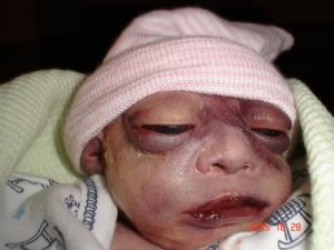 Maryann Elizabeth, baby with anencephaly