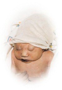 Matthew, baby in Anenzephalie