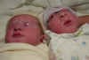 Matthew and Emily, baby with anencephaly