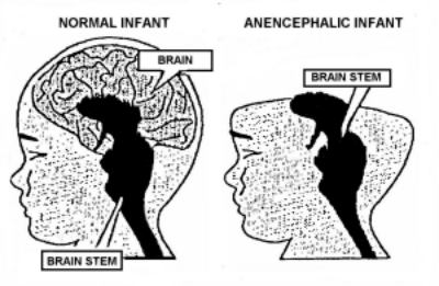 diagram of anencephaly