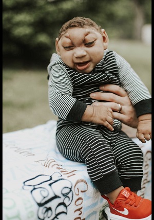 Ozzie Isaiah, baby with anencephaly and encephalocele