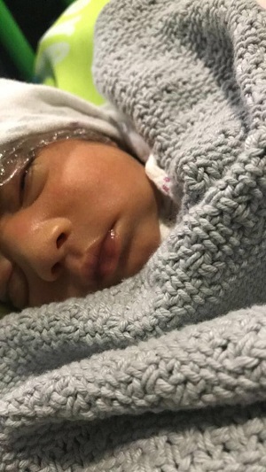 Ruhee, baby with anencephaly