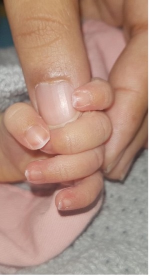 Ruhee, baby with anencephaly