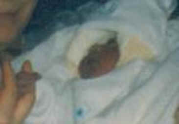 Sebastian Patricio, bebé con anencefalia