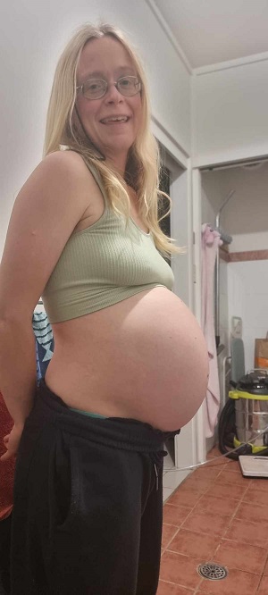 Stephanie Grace, baby with anencephaly