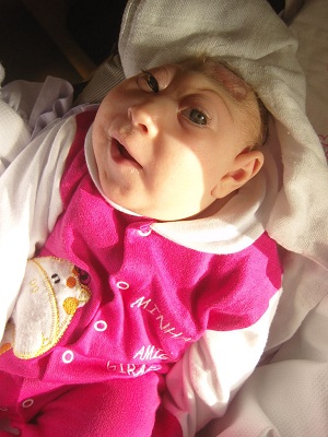 Vitoria, baby with anencephaly
